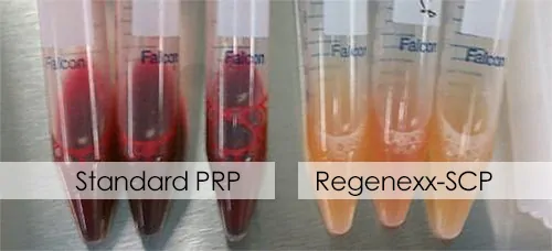 Platelet-rich plasma / PRP